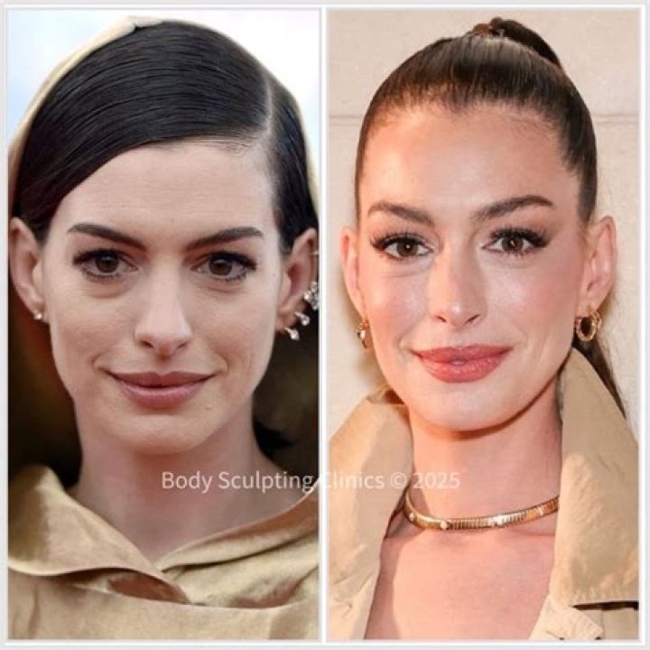 What is Anne Hathaway's Syndrome? Unpacking the Backlash Against Success